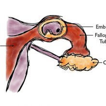 Ectopic Pregnancy