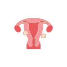 Uterine Fibroids