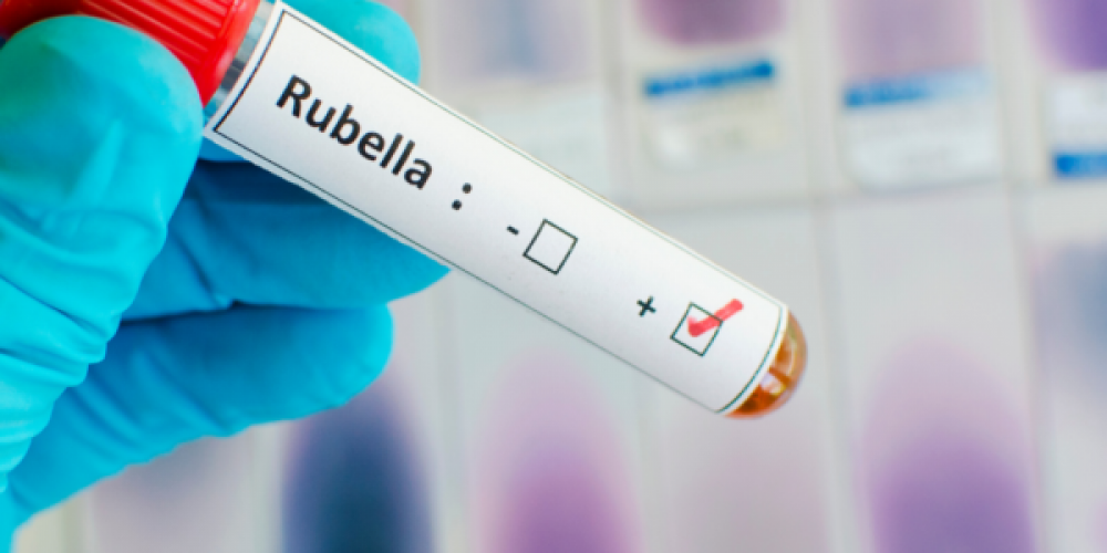 Rubella In Pregnancy  (German Measles)